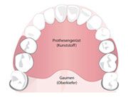Teilprothesen