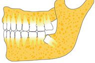 Weisheitszähne