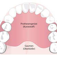 drahtklammerprothesen_mittel