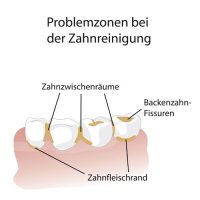 zahnfleischentzuendung-ursachen-problemzonen